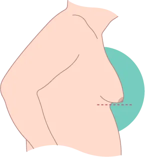 中重度男性女乳症-台北東區男性女乳症手術