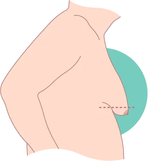 重度男性女乳症-台北東區男性女乳症手術