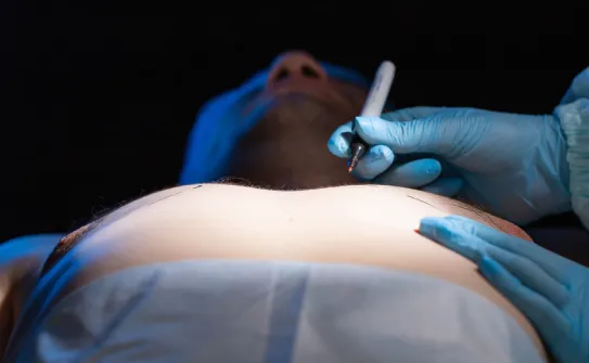 抽脂手術-台北大安男性女乳症手術