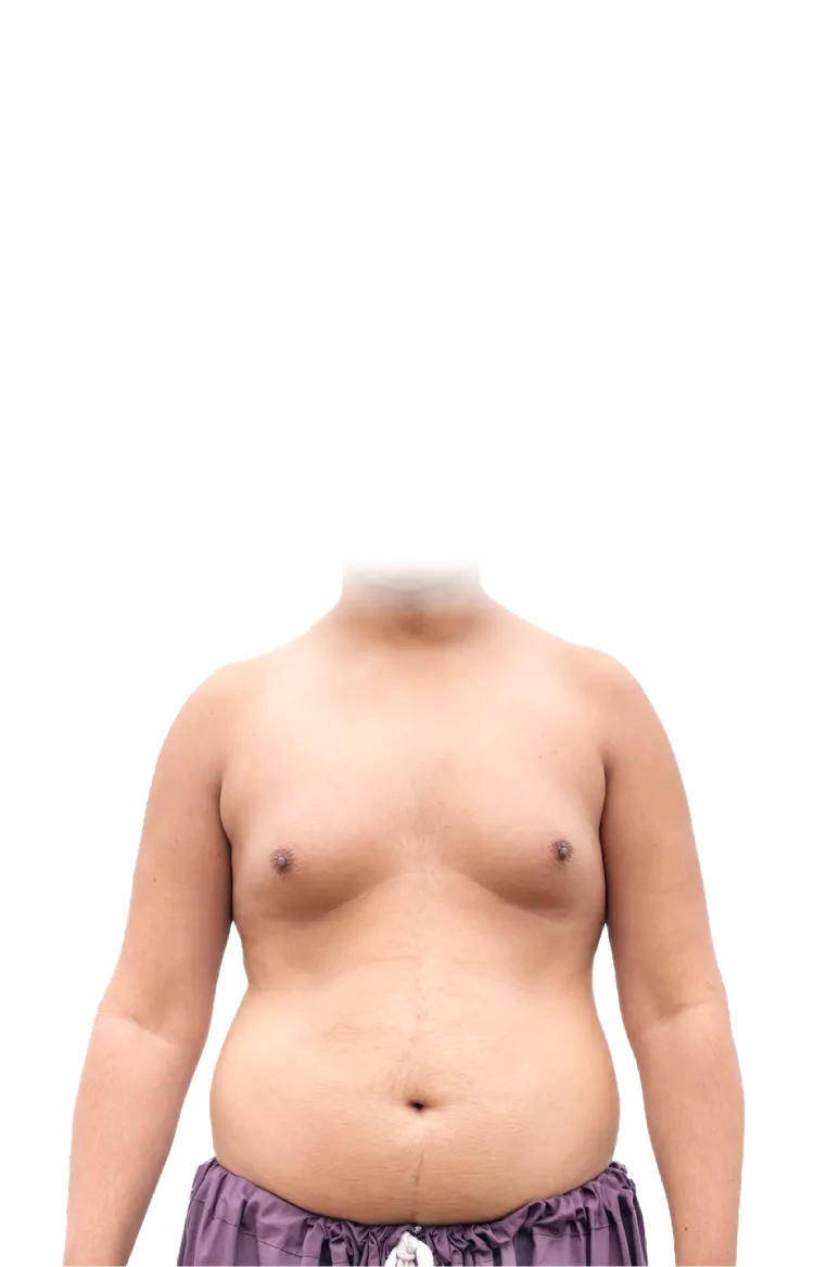 腺體型男性女乳症-台北大安男性女乳症手術