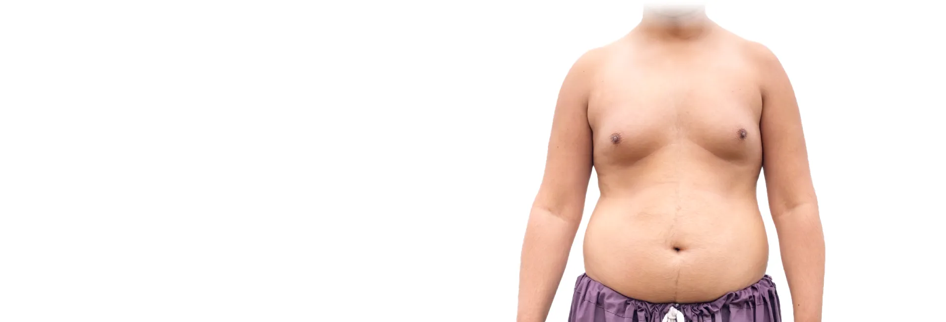 腺體型男性女乳症-台北大安男性女乳症手術