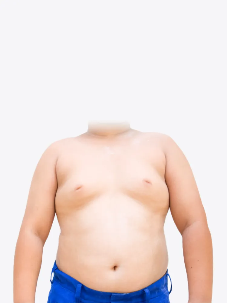 脂肪型男性女乳症-台北大安男性女乳症手術