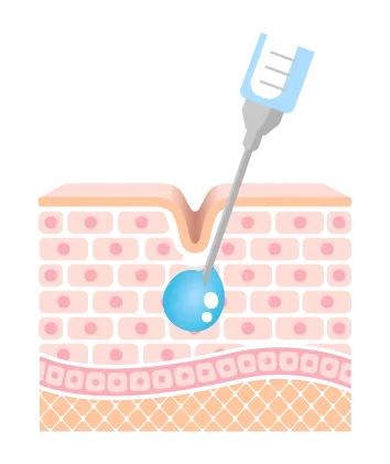 喬雅露作用原理-注射-台北喬雅露推薦