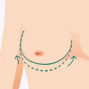 莢膜攣縮-台北隆乳推薦