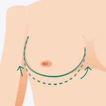 莢膜攣縮-台北大安隆乳推薦